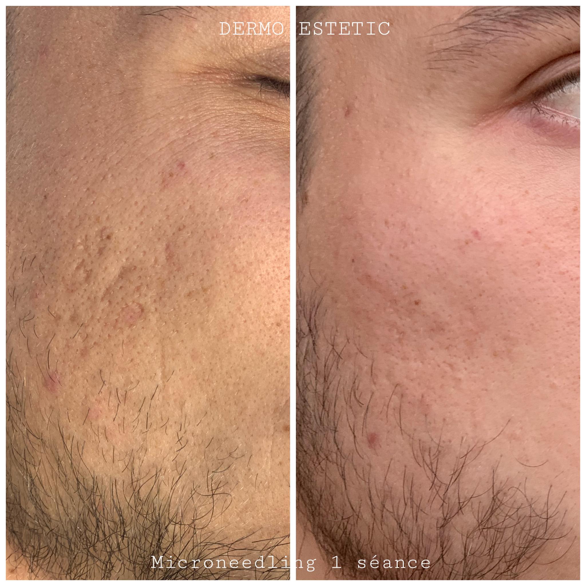 Microneedling