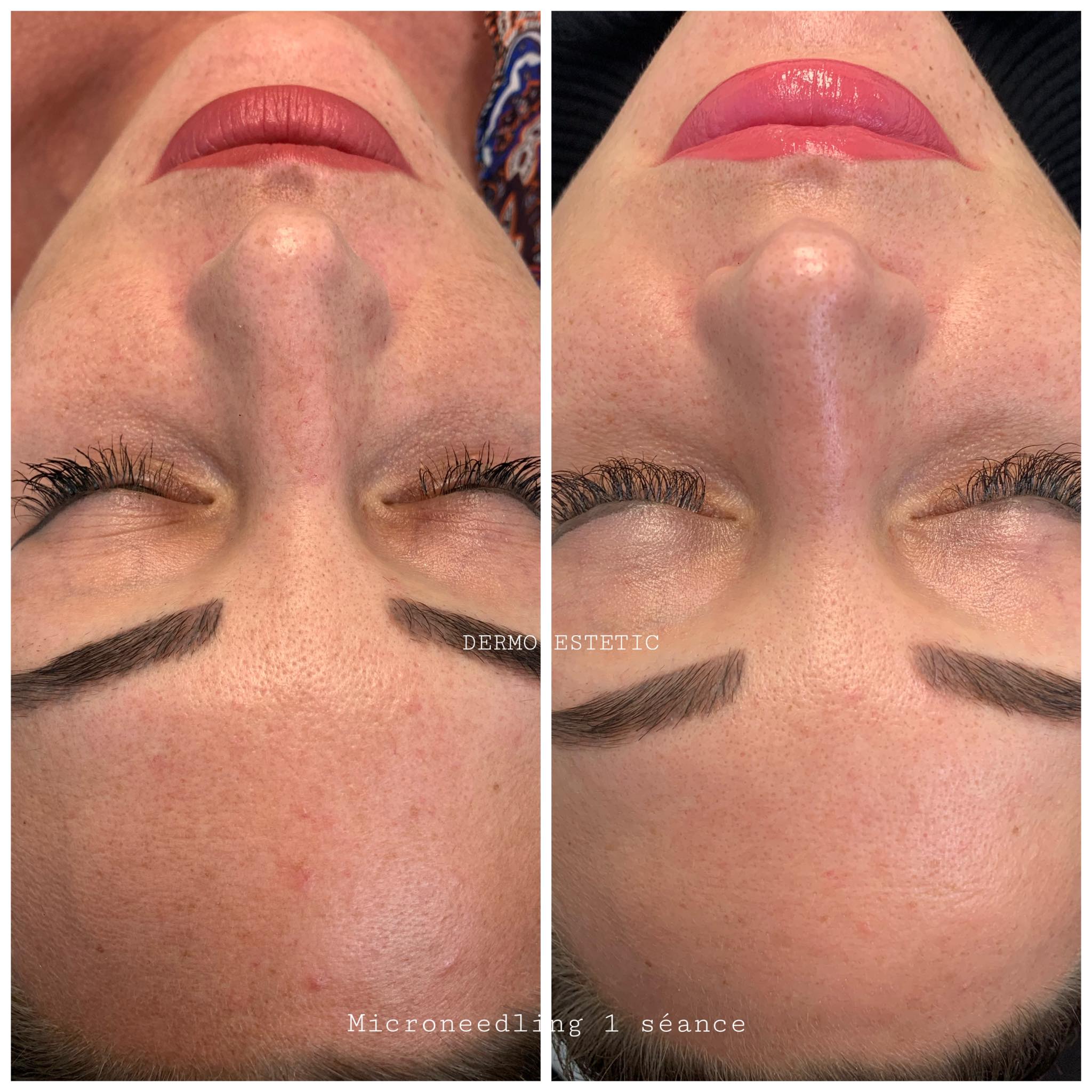 Microneedling
