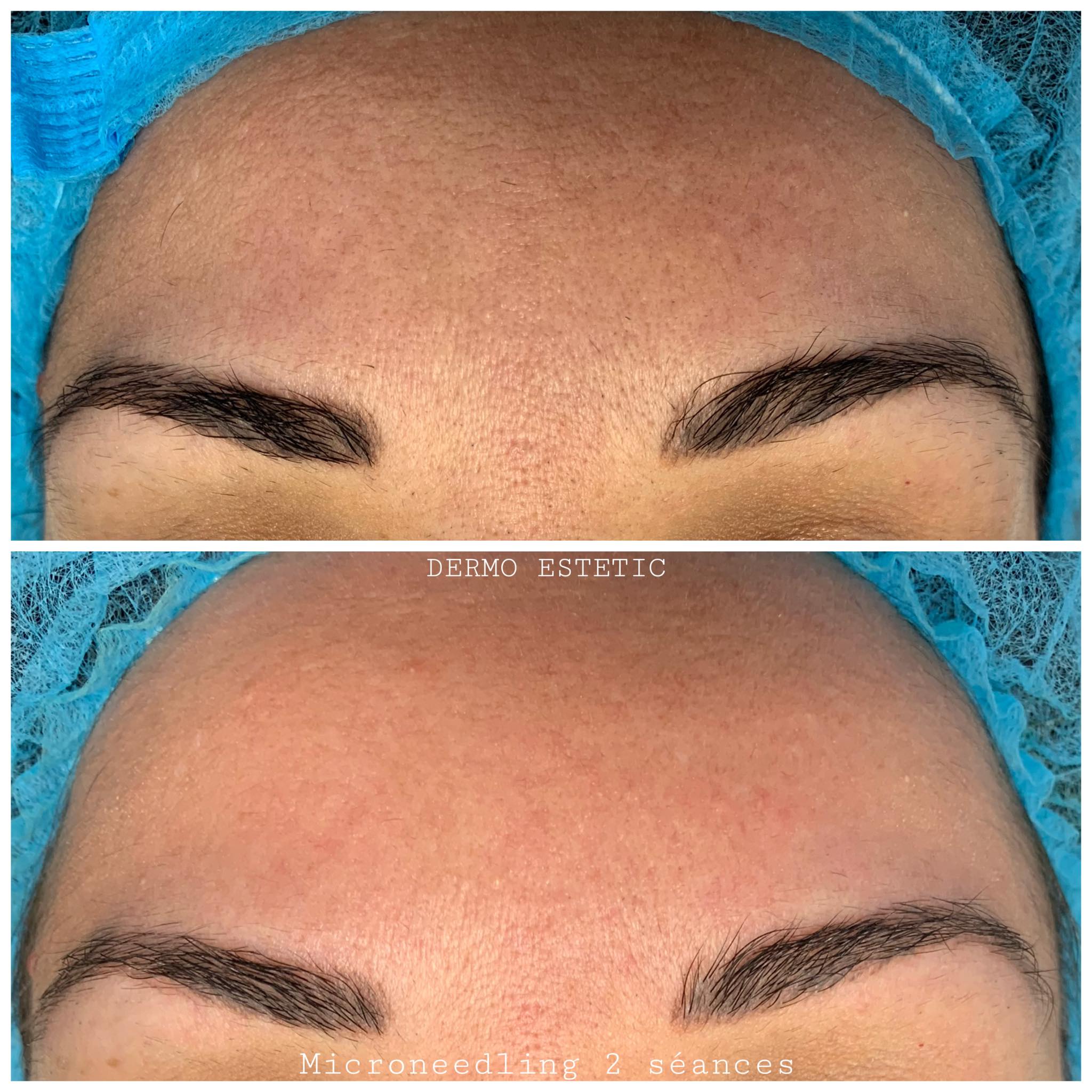 Microneedling