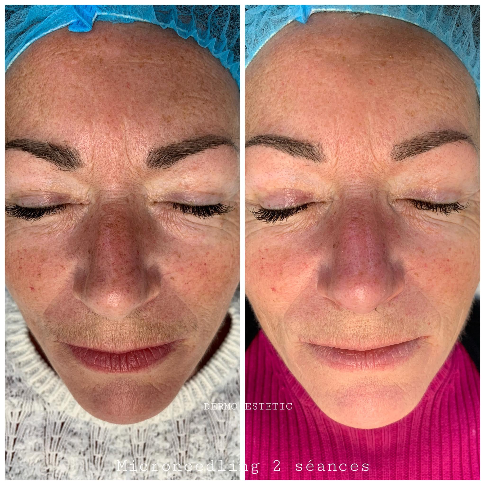 Microneedling