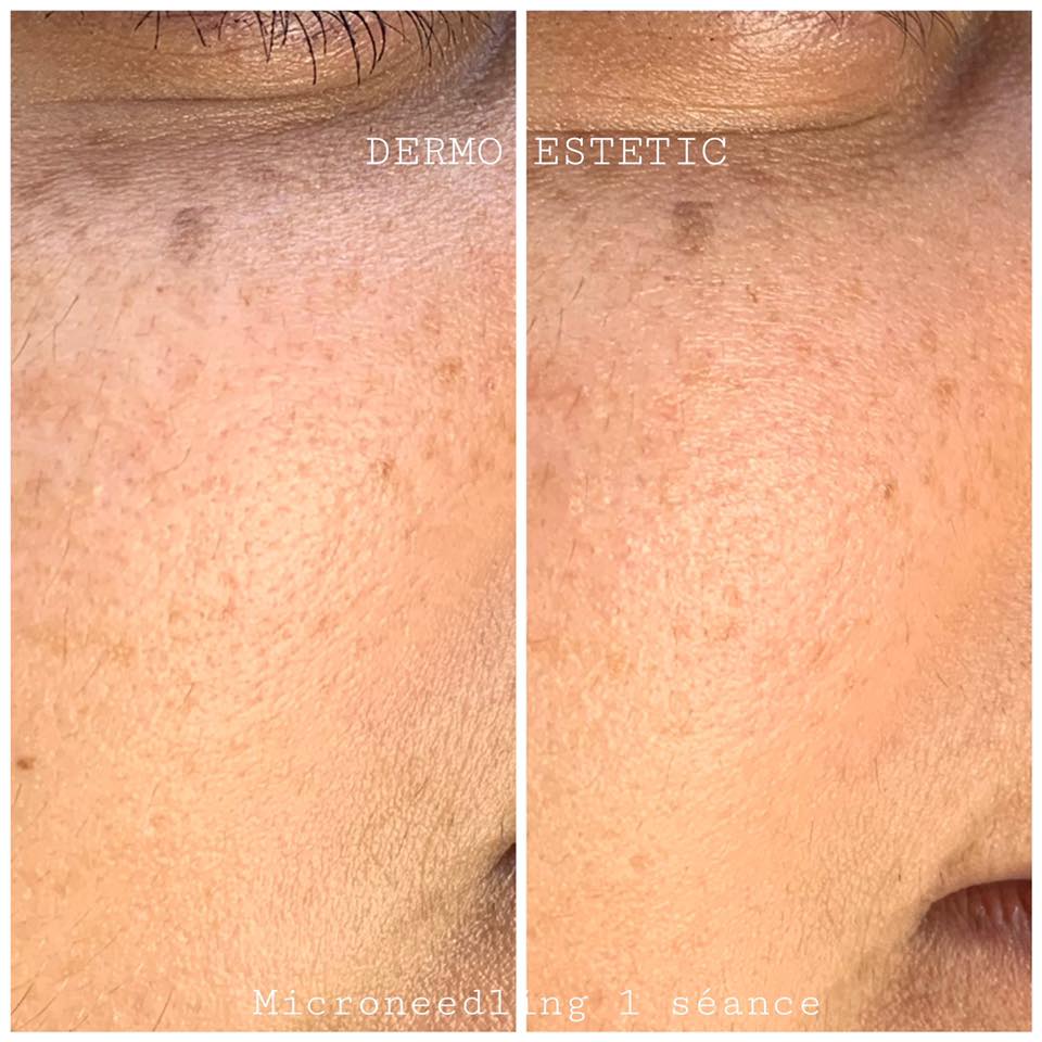 Microneedling 1 séances
