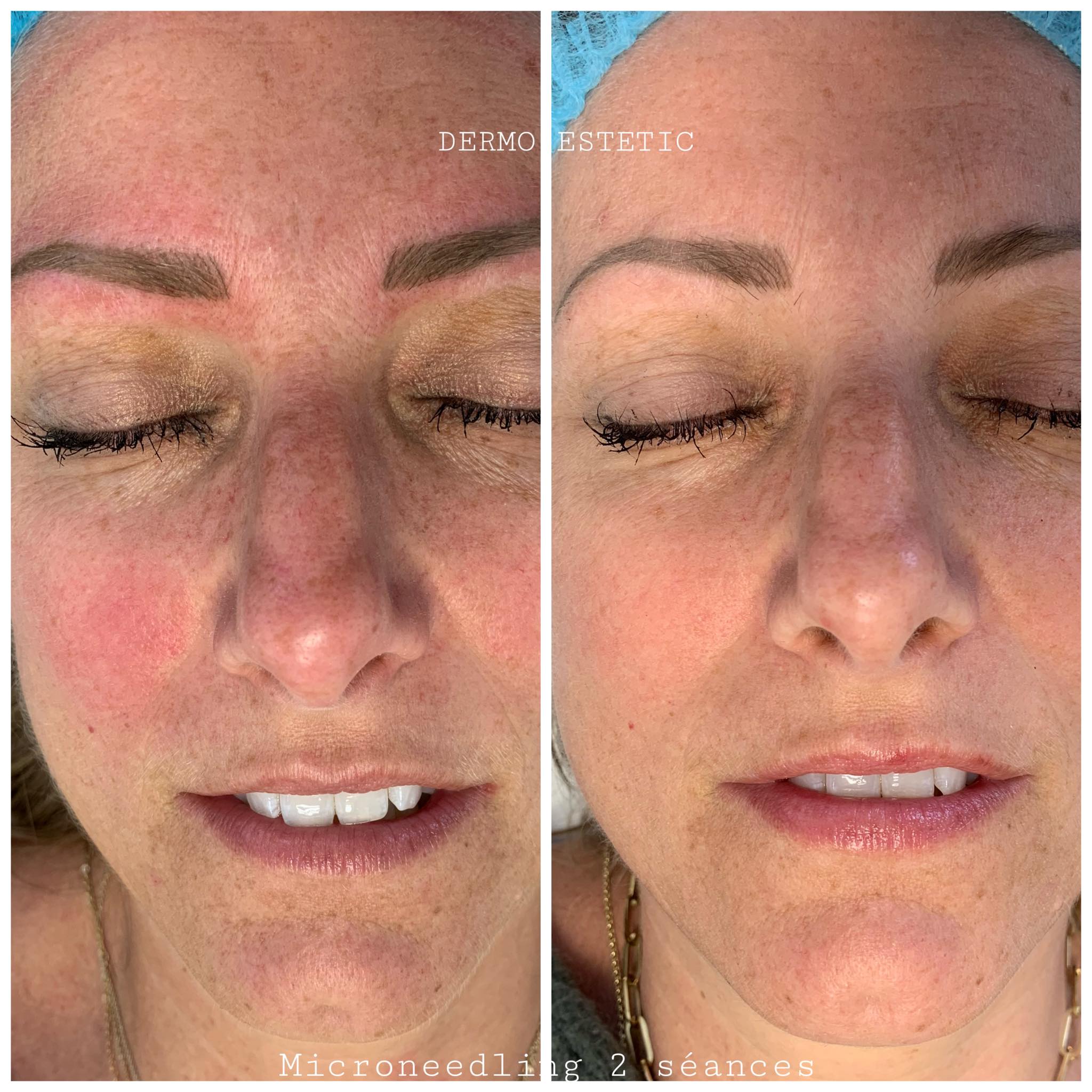 Microneedling