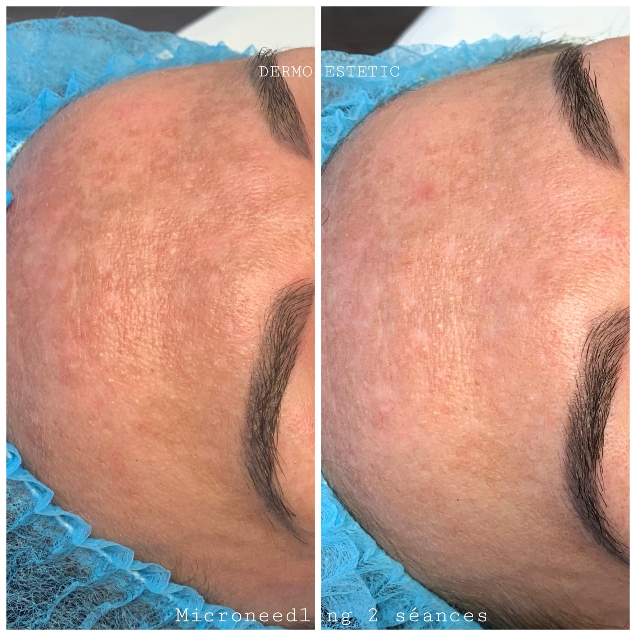 Microneedling