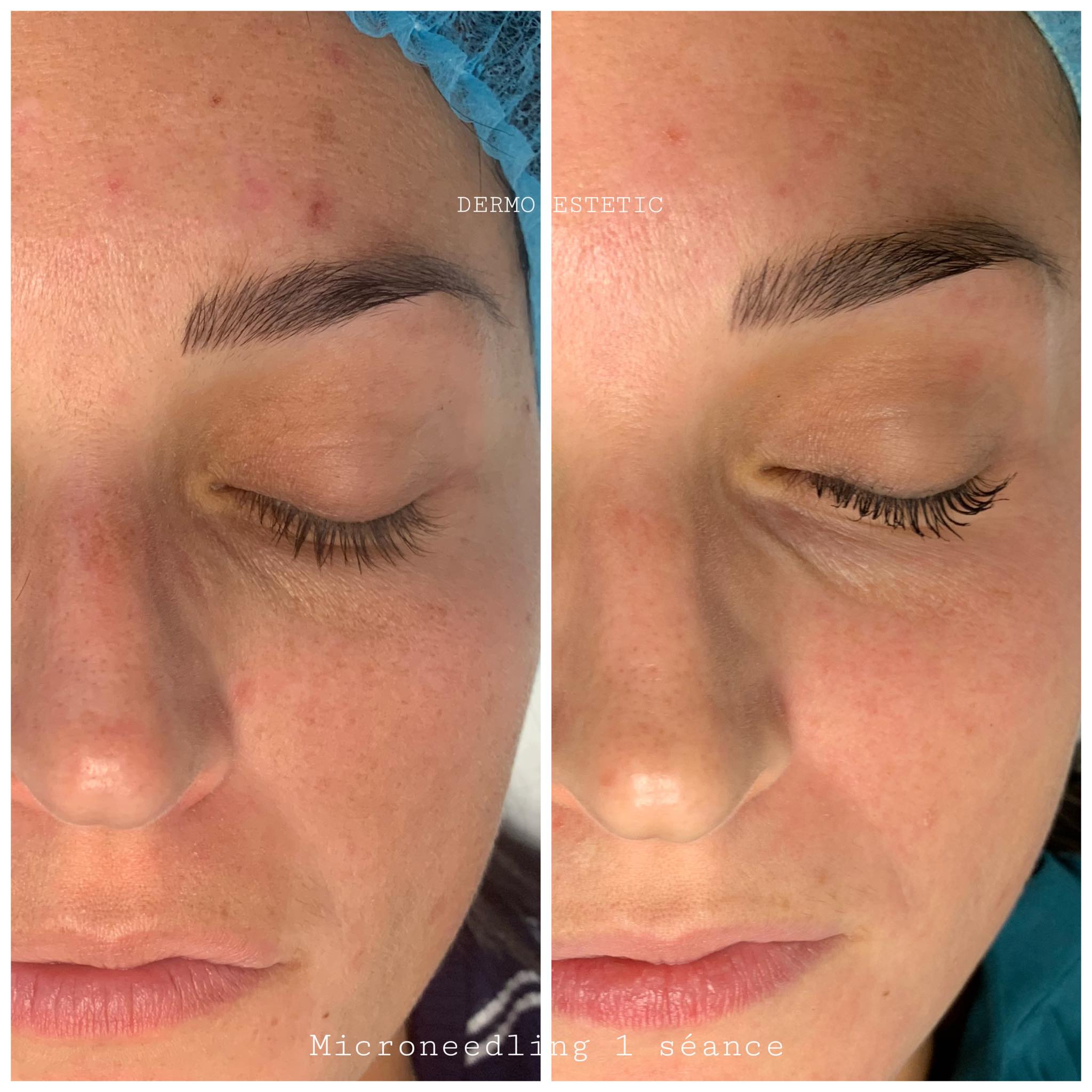 Microneedling