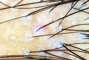 tricoscopia