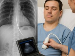 看護師さんによる在宅医療におけるエコーを科学する32~食道胃接合部での経鼻胃管留置確認 ― エコーの活用法