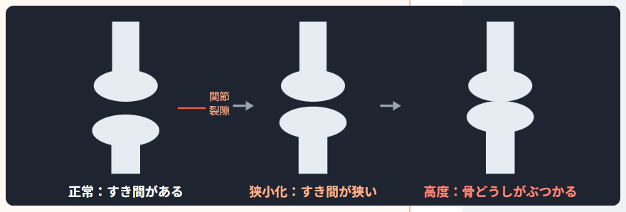 2骨びらん