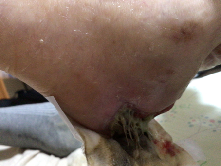 踵部の褥瘡に関するクッション材の提案(在宅医療における褥瘡管理)