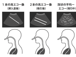 看護師さんによる在宅医療におけるエコーを科学する31~エコーで行う経鼻胃管の評価・判断の手技