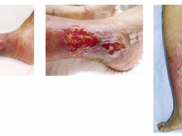 創傷ケア(スキン テア、褥瘡、下肢潰瘍)を科学する25~繰り返す足のただれ…それ、「静脈性下腿潰瘍」かもしれません