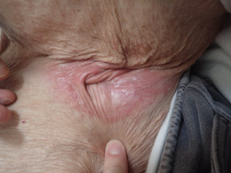 高齢者に多い「腹部の皮膚炎」──実は夏場に要注意!