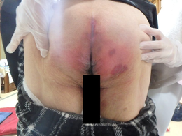 座位中心の生活で悪化した臀部の褥瘡が、クッション変更で改善!