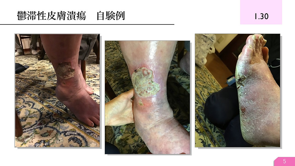 鬱滞性皮膚炎・潰瘍を科学する1