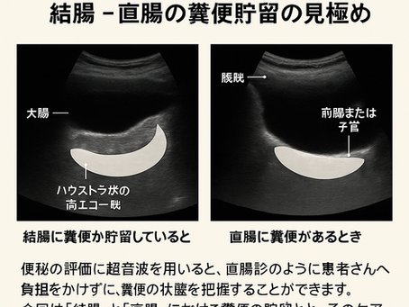 看護師さんによる在宅医療におけるエコーを科学する17~超音波でみる便秘評価 〜結腸・直腸の糞便貯留の見極め〜
