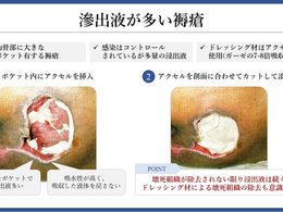 褥瘡を科学する30~浸出液の多い褥瘡への対応 — 処置のポイントとは?