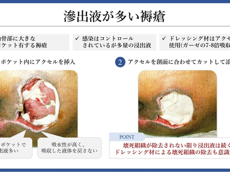 褥瘡を科学する30~浸出液の多い褥瘡への対応 — 処置のポイントとは?