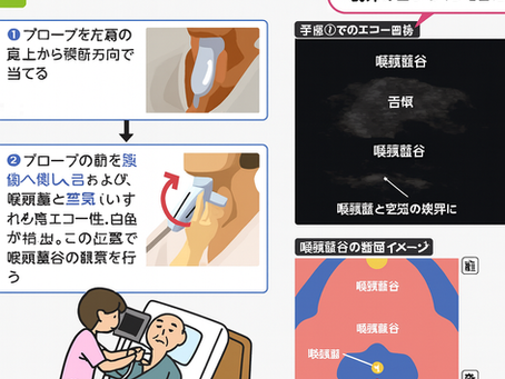 看護師さんによる在宅医療におけるエコーを科学する14~超音波(エコー)で「誤嚥」や「咽頭残留」を可視化する