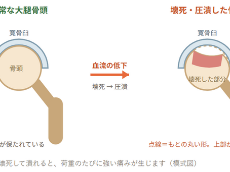 リウマチを科学する２６　大腿骨頭壊死・精神症状・その他 「痛い」「眠れない」の訴えを、副作用として拾う