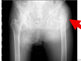 【在宅でみる大腿骨近位部骨折】手術できない高齢者をどう支えるか