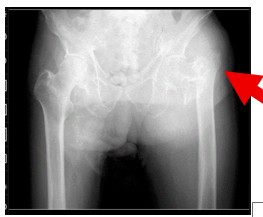【在宅でみる大腿骨近位部骨折】手術できない高齢者をどう支えるか