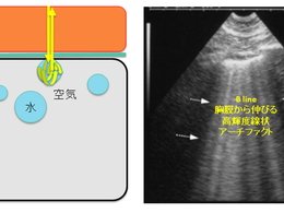 在宅医療で活用される肺エコーによる肺炎診断