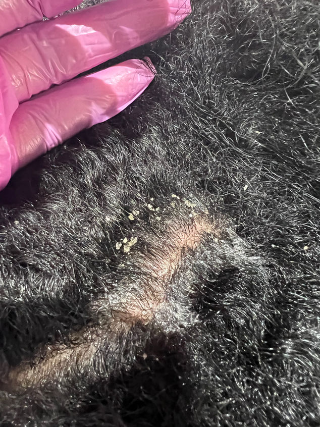 Scalp Disorder