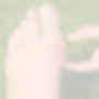 Bunion