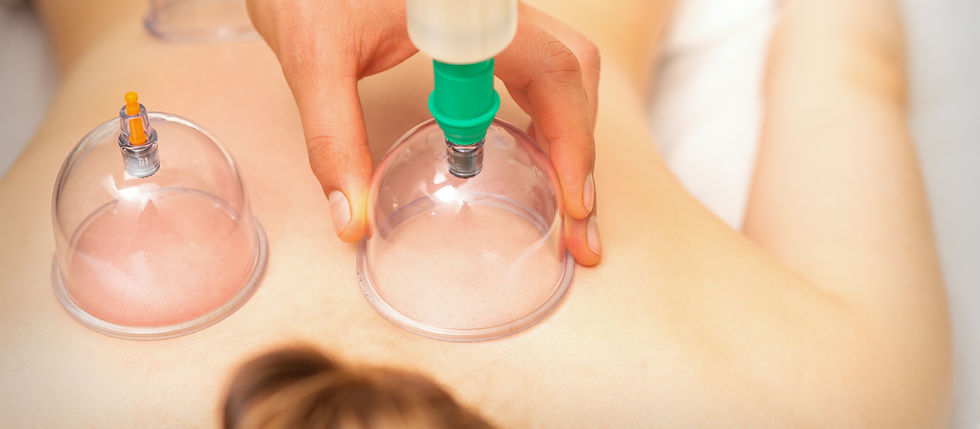 Hand applying cupping therapy cups to a person's back