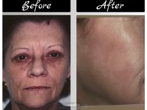 FACIAL WRINKLES REMOVED...AND, NO MORE CROWS FEET!!