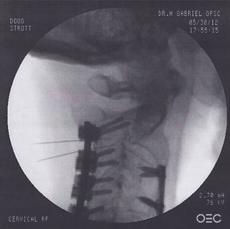 facet injection Xray