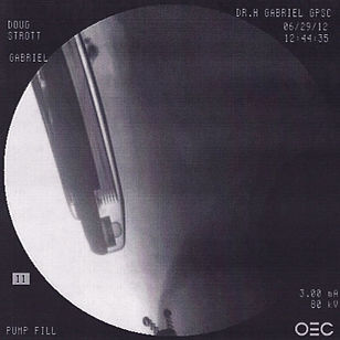Medtronic Pain Pump Implant Xray 