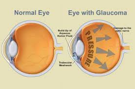 glaucoma.jpeg
