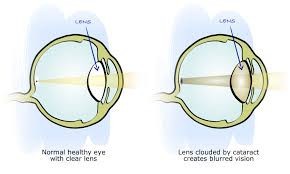 cataract.jpeg