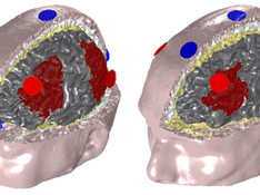 You can do better than following guidelines: improving focus and consistency of the stimulation over multiple subjects, personalized montages boost tCS towards clinical applications.