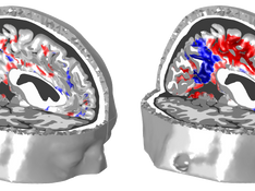 Algorithmic complexity of EEG for neurodegenerative disease progression
