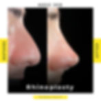 Rhinoplasty Before/After
