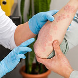 conifer-healthcare-psoraisis-skin-diseases.jpg