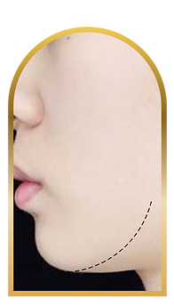 下顎線模糊 埋線提拉 香港醫美診所 All Beauty 全自然輪廓美學專家