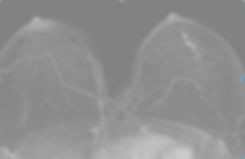 Breast MRI showing left breast DCIS