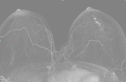 Breast MRI showing left breast DCIS