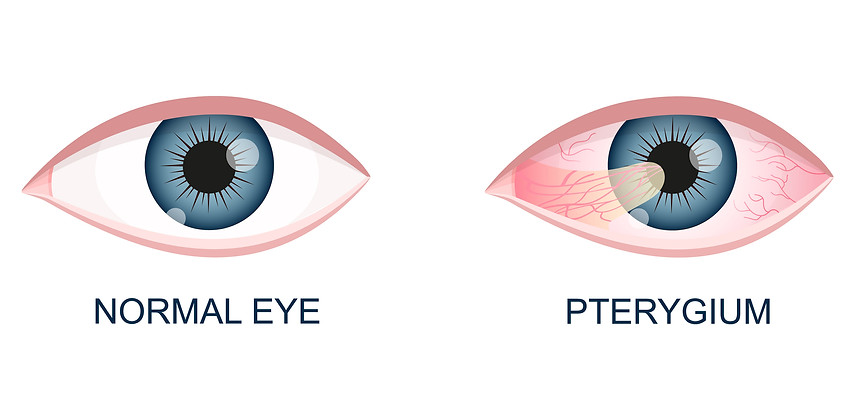 illustration of Pterygium condition