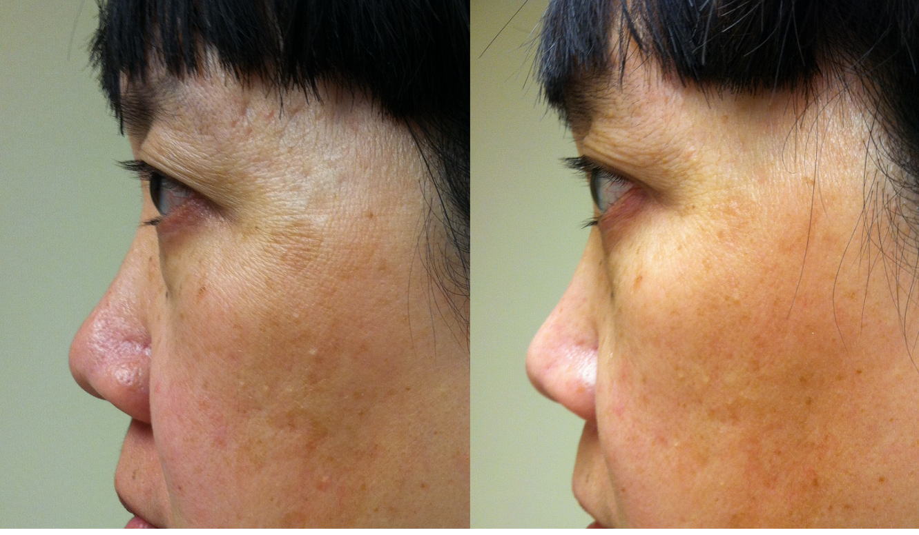 PicoSure Skin Revitalization