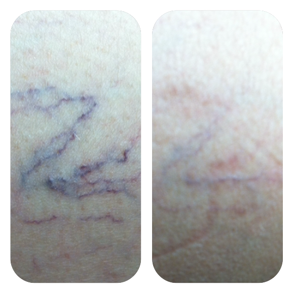 Laser Vein Treatment
