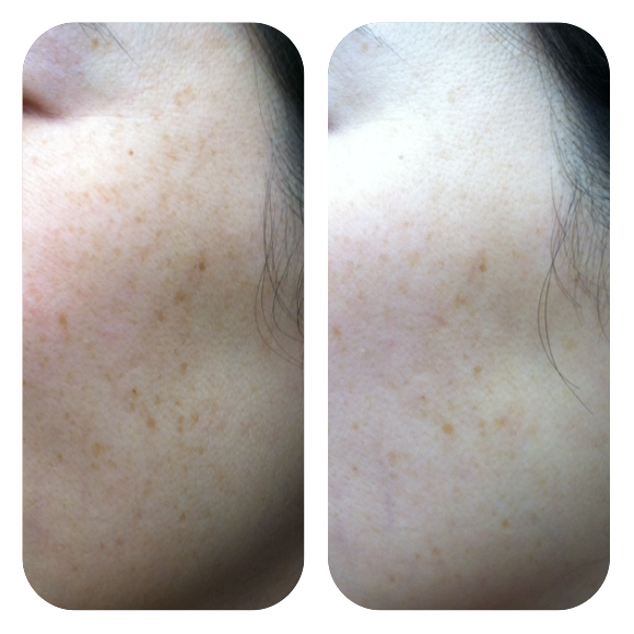 PicoSure Skin Revitalization