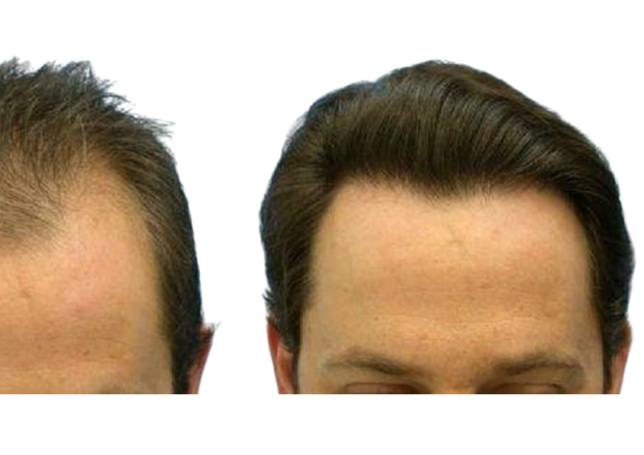 Hair Transplant