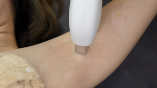 What is Diode Laser "Permanent" Hair Removal