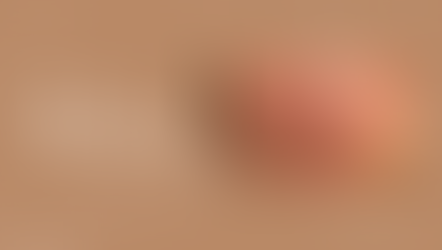 Overcoming Deep Acne Scars with TCA Treatment