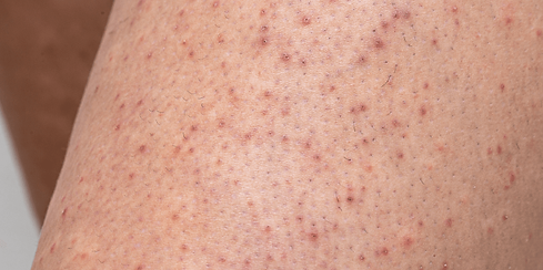 keratosis_pilaris.png