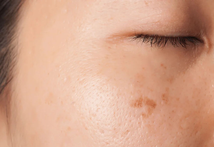 pigmentvlek-gezicht_edited.jpg
