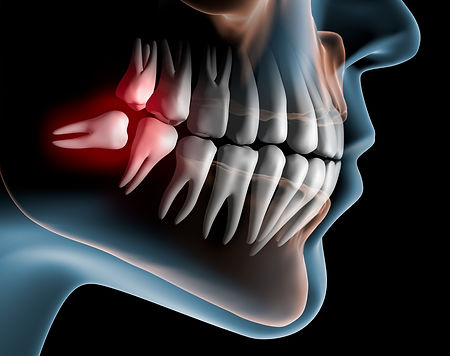 dente do siso, inflamação do siso, dor no dente